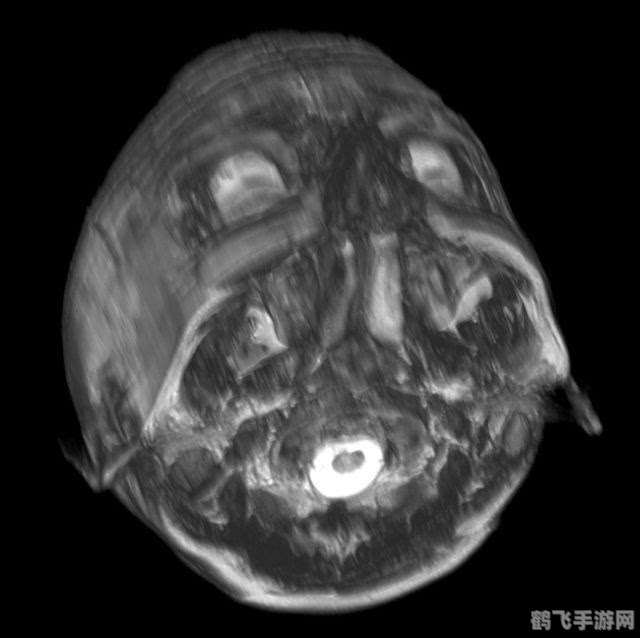 核磁共振前的必备准备:为何必须取下金属饰品?