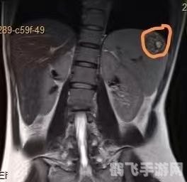 核磁共振前的必备准备:为何必须取下金属饰品?