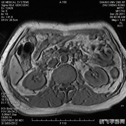 核磁共振前的必备准备:为何必须取下金属饰品?