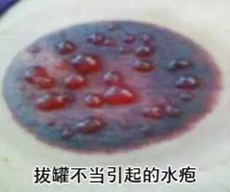 拔罐后留下的印子越大效果越好吗,拔罐印深非效果标杆，手游攻略带你探寻真正的健康之道